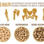 Osteoporosis-Stages-Graph
