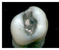 Mercury Tooth Filling