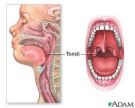 tonsils.jpg