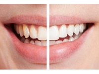 Natural Health Remedies for Teeth Whitening