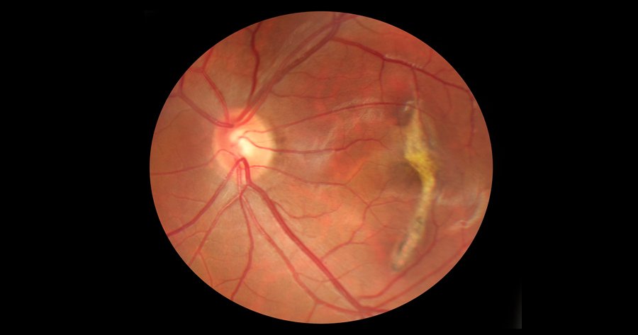 Carotenoids Benefit Our Eyes | Health Blog