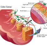 Colon Cancer Rates | Alternative Cancer Remedies Blog