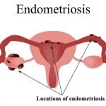 Natural Remedies Endometriosis | Natural Health Blog