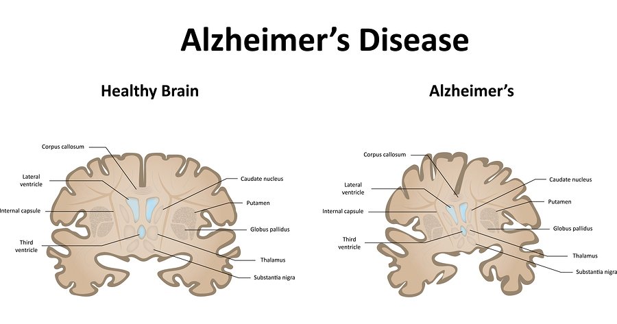 alzheimer's disease: dementia and old age