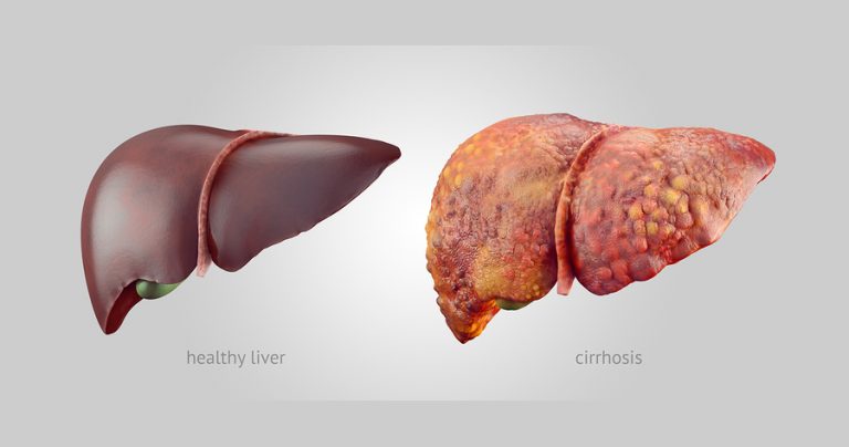 Reversing Cirrhosis of the Liver | Baseline of Health Foundation