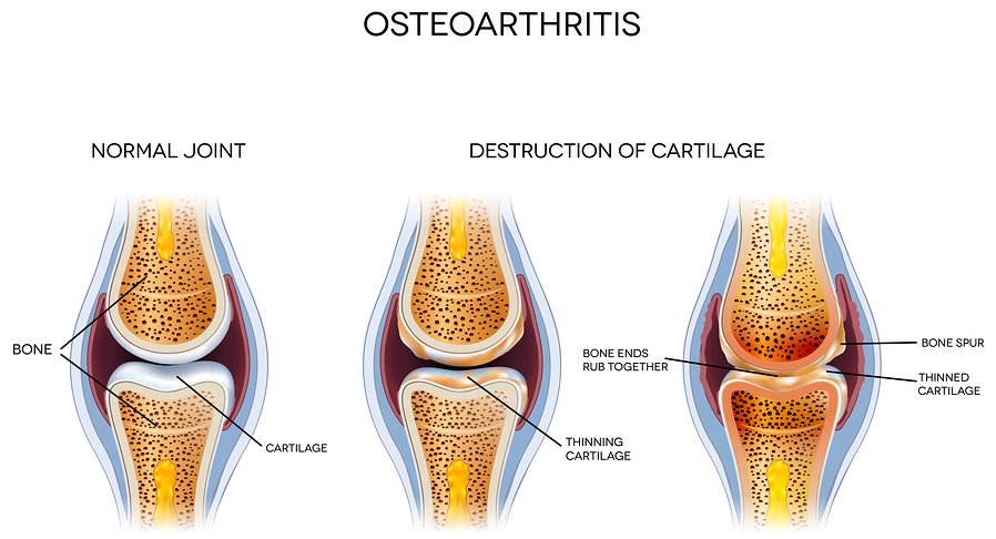 Steroid Shots Linked to Worsening Arthritis Pain