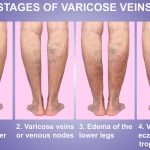 Reduce Varicose Veins | Natural Health Blog